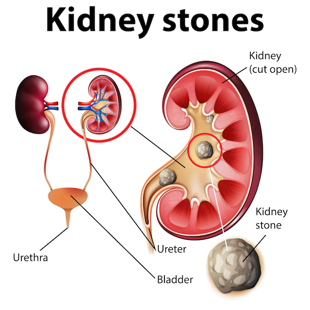 Can a 7mm Kidney Stone Dissolve?